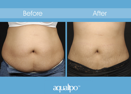 before after nubody orlando lipo liposuction water florida concepts memphis brentwood announces cash tn holiday special jet